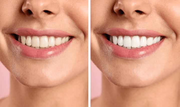 How can I maximize my teeth-whitening results?