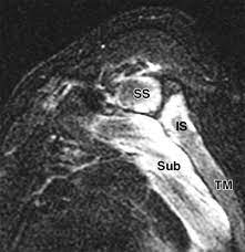 Parsonage Turner Syndrome Mr Imaging Findings And Clinical Information Of 27 Patients Radiology