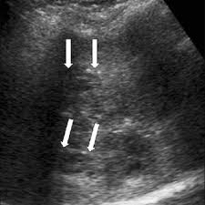 Usg appearance of hydatid cyst. Gharbi And Who Classification Of Hydatid Cysts Disease Of The Liver Download Table