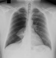 Image result for Pneumothorax