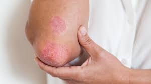Learn what topical and oral medicines, including if someone has scabies, it's important that their sexual partners and any members of their household get treated as well — and at the same time — to avoid. Common Skin Rashes Everyday Health