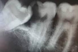 Check out our breakdown of the average prices below. Wisdom Teeth Removal Auckland Wisdom Teeth Surgery Auckland Wisdom Teeth Removal Cost Auckland