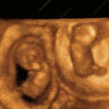 Maybe you would like to learn more about one of these? 10 Week Twin Foetuses 3 D Ultrasound Stock Image P680 0757 Science Photo Library