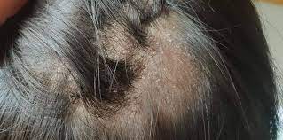 Kulit kepala gatal yang mengganggu bisa disebabkan oleh beragam masalah kesehatan kulit kepala. Tinea Capitis Infeksi Jamur Di Kulit Kepala Anak Yang Sangat Menular Theasianparent Indonesia