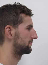 Male Rhinoplasty Before & After