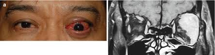 Image result for Dacryoadenitis