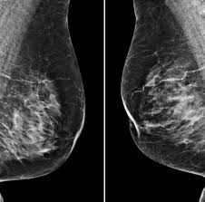 What does breast cancer look like? Artificial Intelligence Could Help To Spot Breast Cancer Imperial News Imperial College London