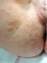 What is molluscum contagiosum virus and how does it spread? Prise En Charge Par Laser De Molluscum Contagiosum Genitaux Profus Apparus Sous Fingolimod Sciencedirect