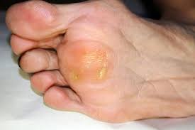 Here is another extreme case of dead skin build on feet. Corns And Calluses What S The Difference And How Can I Treat Them