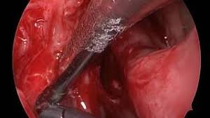 Alexandru trestioreanu, din bucurești, a fost lansat ghidul supravieţuitorului de cancer, ediţia în limba română. Cancerul Foselor Nazale È™i Al Sinusurilor Paranazale Spitalul Monza