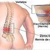 Spinal disc herniation is an injury to the cushioning and connective tissue between vertebrae, usually caused by excessive strain or trauma to the spine. 1