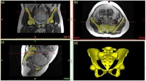 Three Dimensional Magnetic Resonance Pelvimetry A New Technique For Evaluating The Female Pelvis In Pregnancy European Journal Of Radiology
