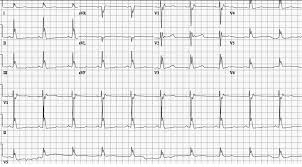 Camels have humps on their backs as places to store fat. Http Www Siacardio Com Wp Content Uploads 2015 01 Respiratory Arrest And Cardiovascular Collapse In A Young Autistic Woman1 Pdf