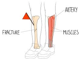 Image result for Compartment Syndrome