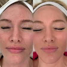 Natural skincare solutions for acne and aging