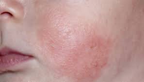 Skin Asthma: Causes, Symptoms and Treatment