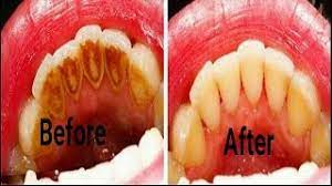 Fill the glass with a mixture of white vinegar and distilled water, using approximately half of each. How To Remove Yellow Stains From Teeth At Home Youtube