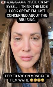 RHOC's Emily Simpson looks unrecognizable as she debuts her fresh new face  after eyelift surgery