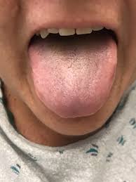 Image result for black tongue symptoms