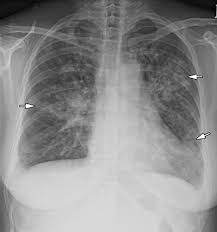Pneumonia lung stock photos & pneumonia lung stock images. Radiographic And Ct Features Of Viral Pneumonia Radiographics