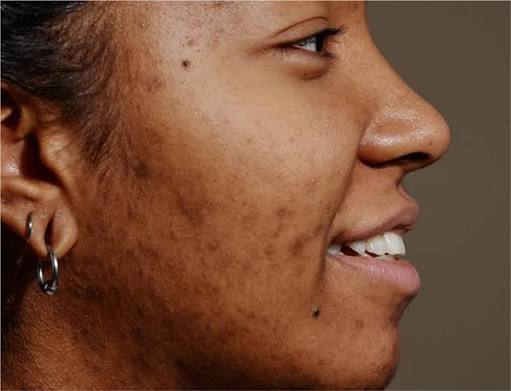 Dark spots & marks