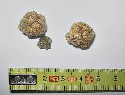 How To Flush Out Gallstones Gallstones Gallbladder Flush Salt Flush