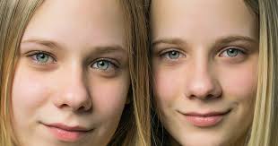 Recuerdas a las bebés trillizas, con las mellizas unidas? ¡Ahora tienen 16  años de edad!