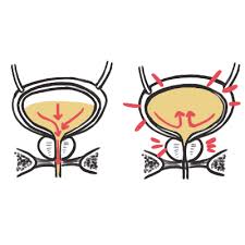 Image result for Urinary Retention