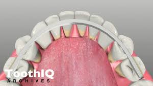 For many, loose tooth issues arise from gum problems and bone loss (1). Periodontal Stabilization Splints Youtube