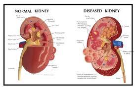 Most primary renal diseases eventually disturb sodium and volume control sufficiently to produce clinical hypertension. End Stage Renal Disease Chronic Kidney Disease