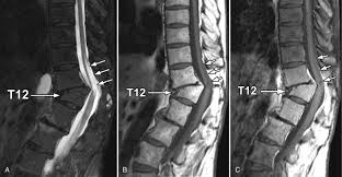 Image result for Syringomyelia