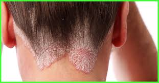 We turned to infectious disease experts to set things straight. How To Get Rid Of Fungal Scalp Infection 8 Natural Remedies