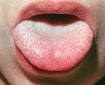 White tongue can be an indicator of diseases. Ask Ayurveda How Do I Get Rid Of The White Coating On My Tongue Svastha Ayurveda