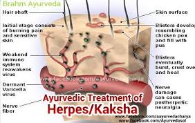 Nerve regeneration proceeds from the peripheral recipient cornea into the donor cornea very slowly and, even ravi v. Behandlung Von Herpes Zoster Das Ayurveda Haus An Der Alten Linde Facebook