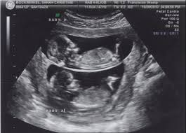 Tentunya, melihat gambar bayi yang masih berbentuk janin tersebut menjadi. 25 Ide Usg Gambar Bayi Usg Bayi Lucu