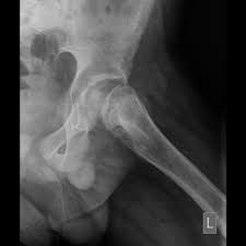 The foot bones shown in this diagram are the talus, navicular, cuneiform, cuboid, metatarsals and calcaneus. Pediatric Hip Frog Leg Lateral View Radiology Reference Article Radiopaedia Org
