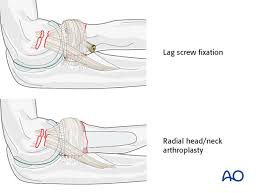 Image result for Radial Head Dislocation