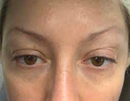 Trim any hairs above your eyebrow line with grooming scissors. I Got An Eyebrow Transplant Photos Allure