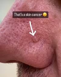 Image result for skin cancer on nose pimple