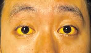 } other autoimmune disorders, such as thyroiditis. Ramai Penghidap Tiada Gejala
