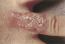J eur acad dermatol venereol 2000; Tuberculosis Verrucosa Cutis Eref Thieme