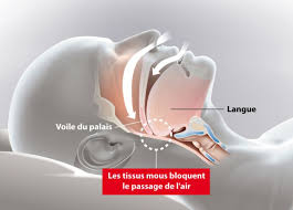 Ecran de controle lcd couleur. Apnee Du Sommeil Hopital Prive Est Lyonnais