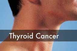 A lump in the front of the neck, near the adam's apple Thyroid Cancer Know Causes Symptoms Management Dr Piyush Kumar Agrawal