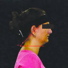 PDF) Protrusão da cabeça em adultos com cefaleia