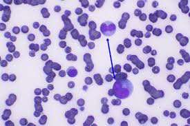 Leucemia mieloide cronica negli stati uniti alcuni anni fa negli stati uniti, per esempio. Leucemia Mieloide Aguda Diagnostico Veterinario