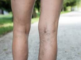 Etiologia existen varios factores de riesgo bien reconocidos que actúan para Trombosis Venosa Profunda 1Âª Parte Manejo En Fase Aguda Blogs Quironsalud