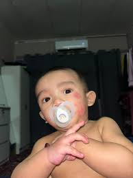 Ada tips tak nak tapper down steroid cream macam mana?