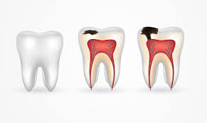 Bệnh s&acirc;u răng: Dấu hiệu, nguy&ecirc;n nh&acirc;n v&agrave; c&aacute;ch điều trị | Bệnh Viện Răng H&agrave;m  Mặt TPHCM