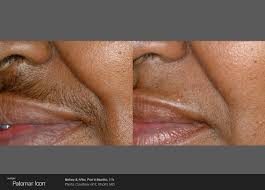 May pay at each treatment. Laser Hair Removal Aqua Med Spa Ocala Plastic Surgery