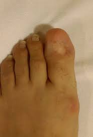 Image result for Onychogryphosis feet
